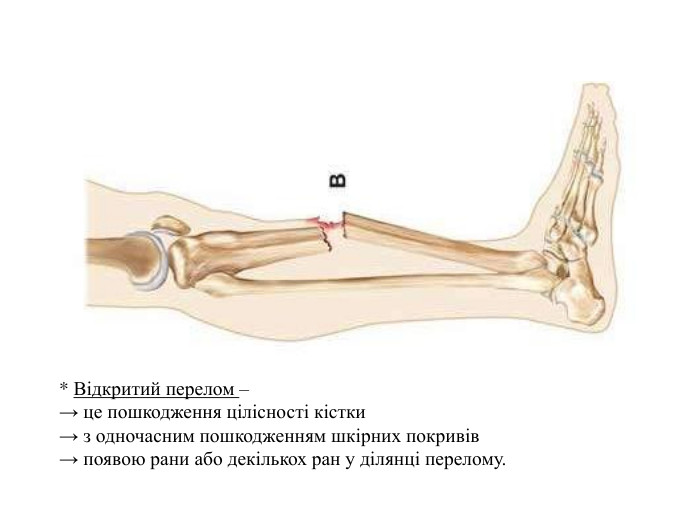 відкритий перелом
