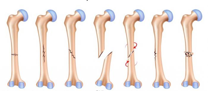 види переломів